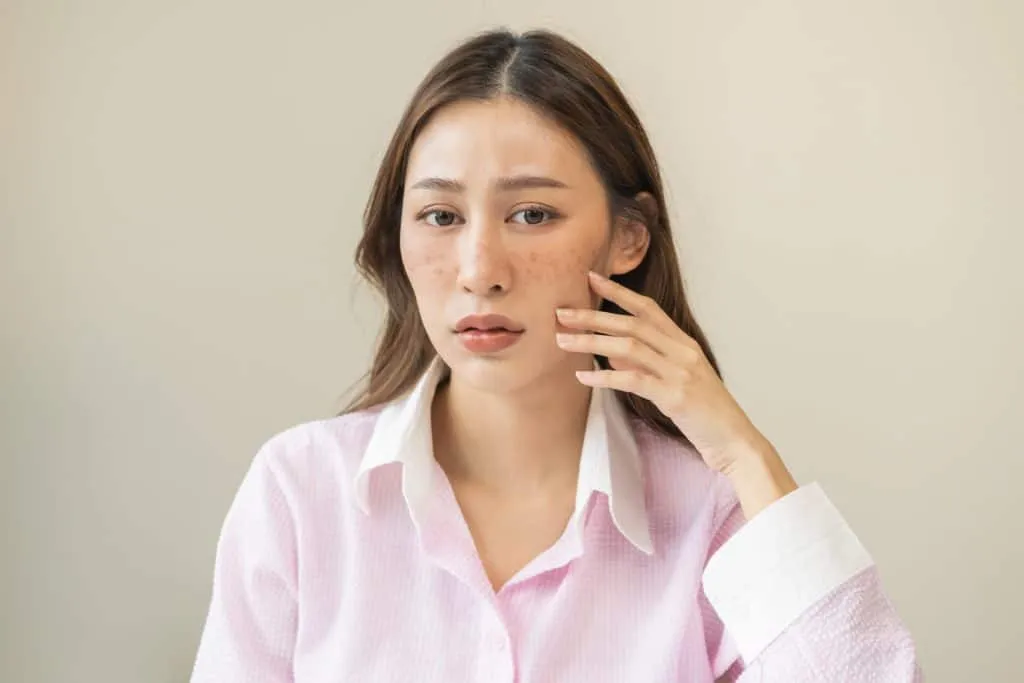 How can I treat Hyperpigmentation / Melasma? 1 Hyperpigmentation & Melasma Treatment at Parlour at the Village in Salado, TX