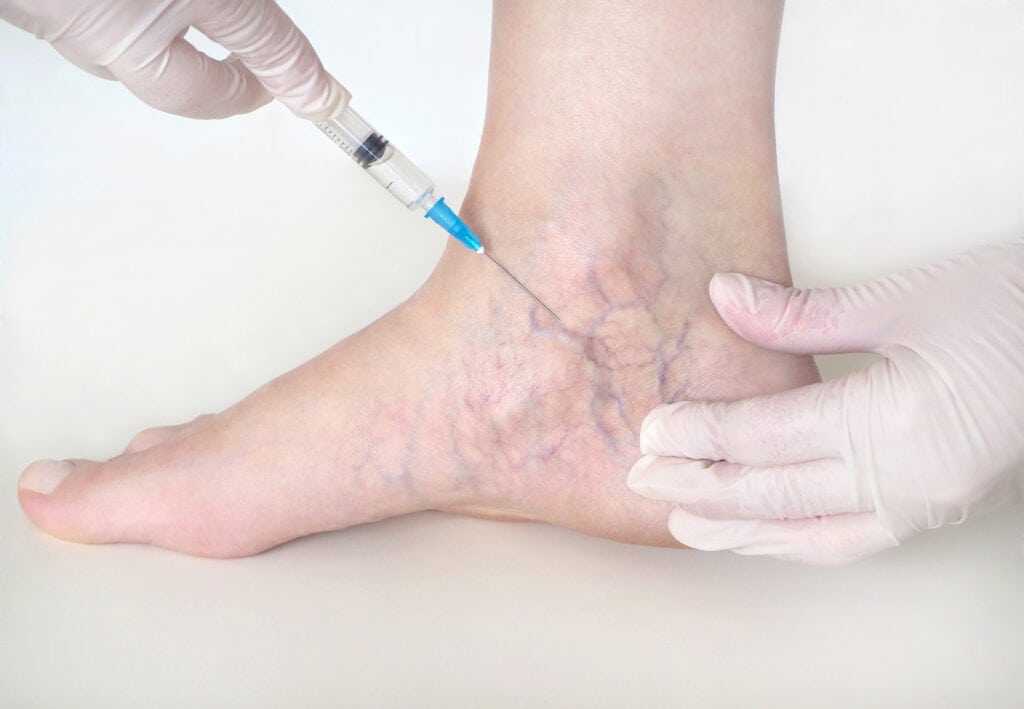 Doctor Giving Sclerotherapy Injection on Patient's Leg | Parlour at the Village in Salado, TX