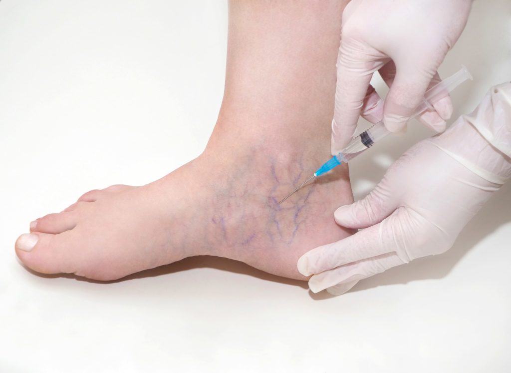 What's the Difference Between Sclerotherapy and Laser Treatment