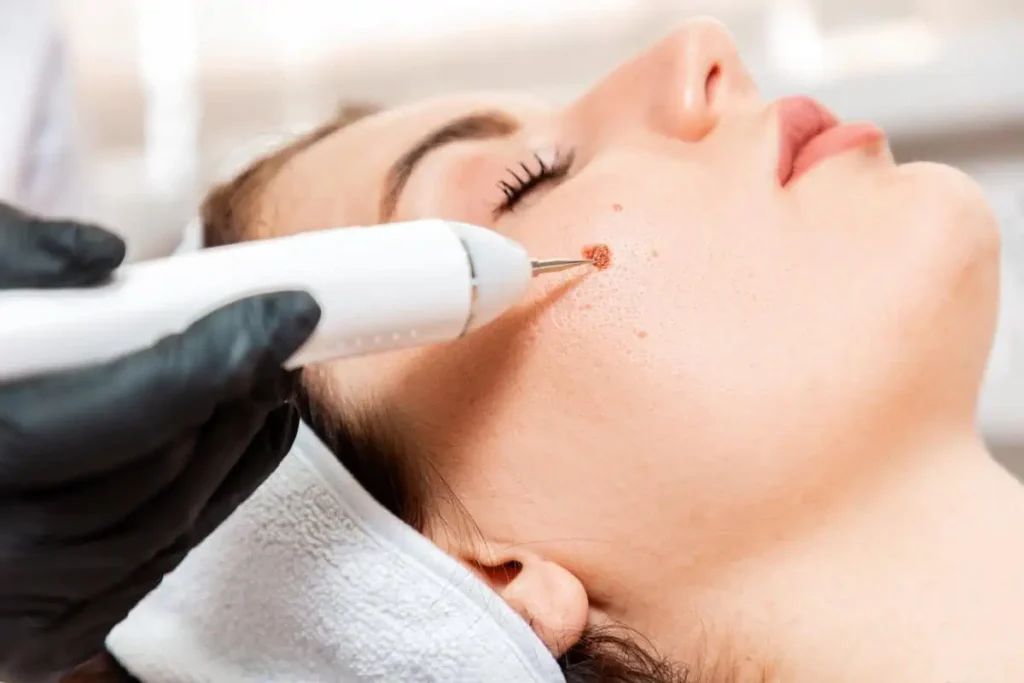 Cosmetic Mole Removal at Parlour at the Village in Salado, TX