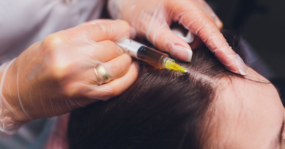 Medical professional injecting PRF (Platelet Rich Fibrin) into the scalp for hair restoration therapy.
