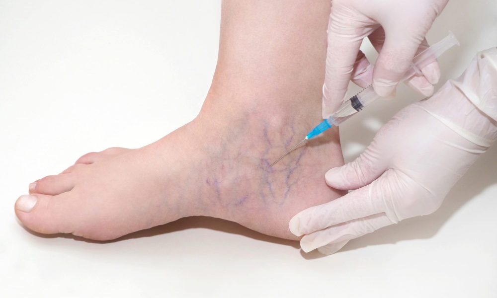 What's the Difference Between Sclerotherapy and Laser Treatment