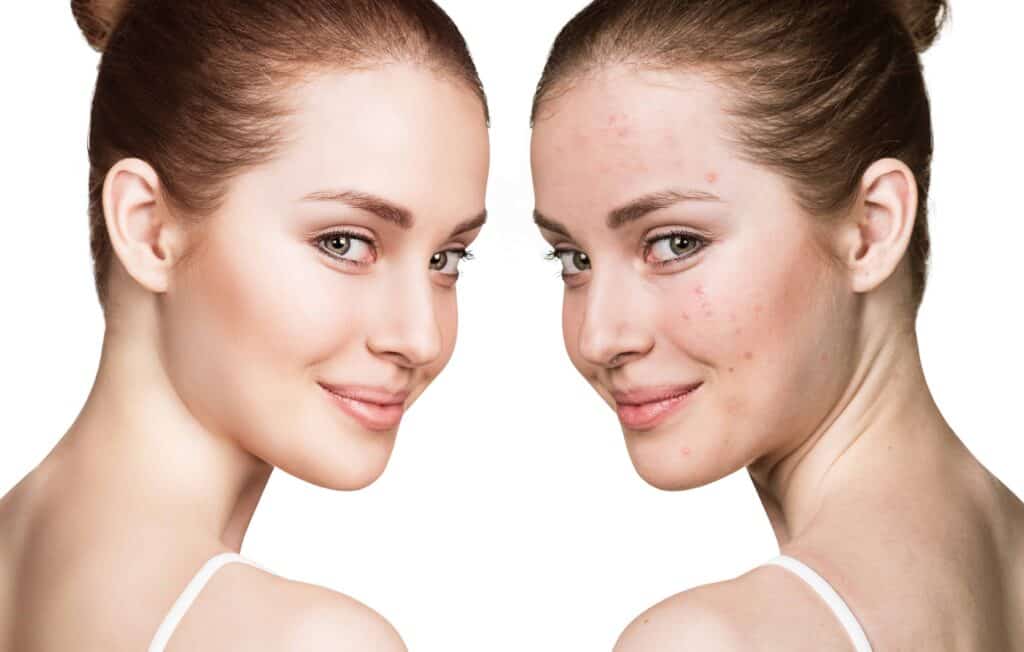 How Does Microneedling with PRF Enhance Your Skin? Key Benefits and Recovery 1 Microneedling, Microneedling with PRF, microneedling with prf before and after, what is microneedling with prf,microneedling with prf benefits