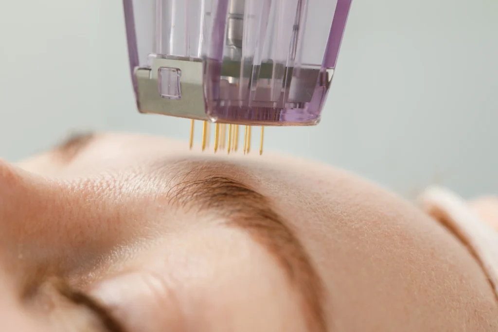 Microneedling device needles on a female forehead | Microneedling With PRF in Salado, TX at Parlour at the Village