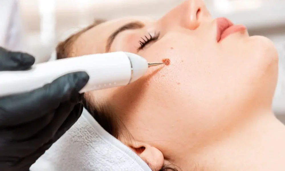 Cosmetic Mole Removal at Parlour at the Village in Salado, TX